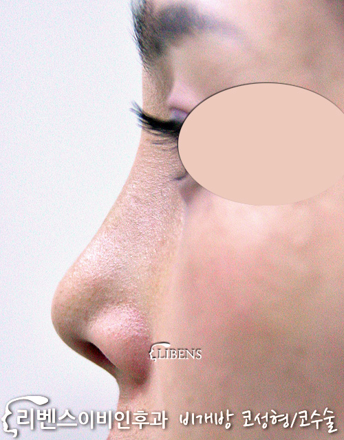 심한 휜코 수술 교정 발육 부전 코끝 매부리코 메부리코 여자 성형 s113